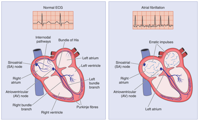 hypoxemia can affect your heart