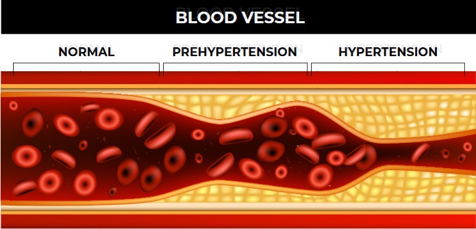 Blood Vessels affected by sleep apnea